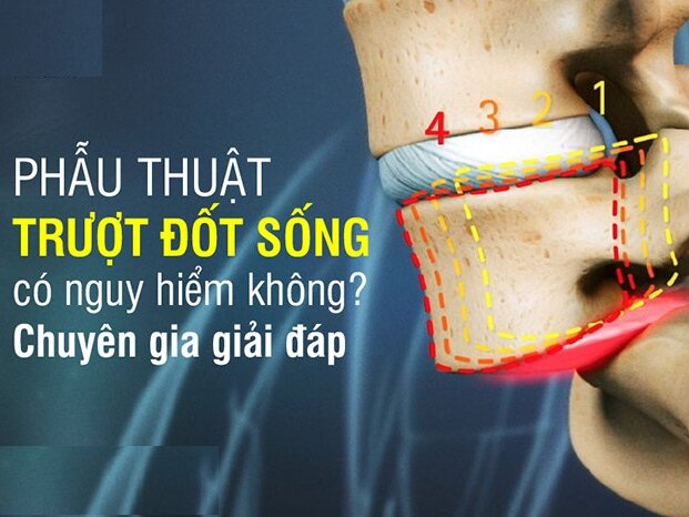 Phẫu thuật trượt đốt sống có nguy hiểm không?